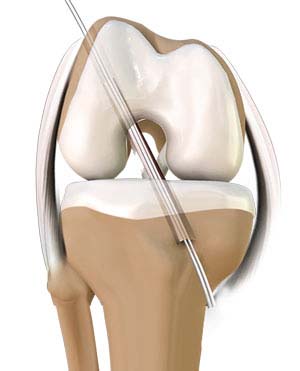 Knee Arthroscopy
