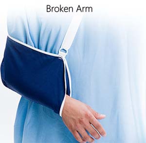 Broken Arm