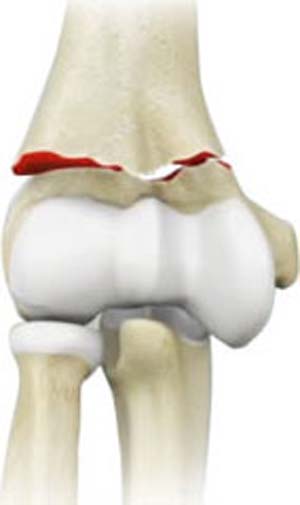 Olecranon (Elbow) Fractures