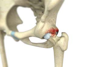Femoro Acetabular Impingement
