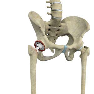 Joint Replacement Surgery