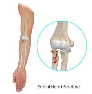 Radial Head Fractures