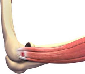 Lateral Epicondylitis